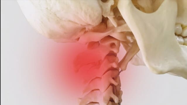 ストレートネックが悪化して神経を圧迫している頚椎（首の骨）のイメージ