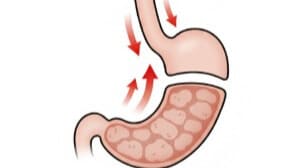 卵黄の脂質が原因で、胃の動きが止まり、食道の弁(LES)が緩んで胃酸が逆流するメカニズムの図解。
