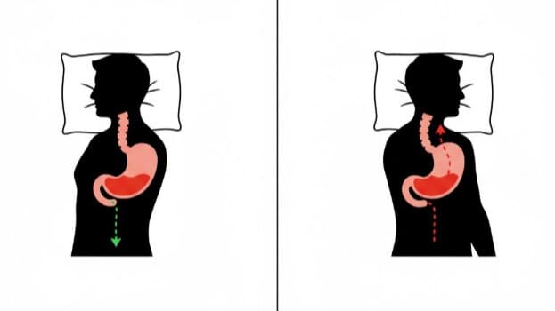 胃の形状と寝る向きの関係を示すイラスト。左向きで寝ることで胃酸が逆流しにくくなる様子