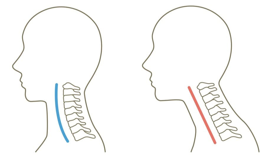 正常な頸椎の前彎カーブと、カーブが失われたストレートネックの骨格比較図解。
