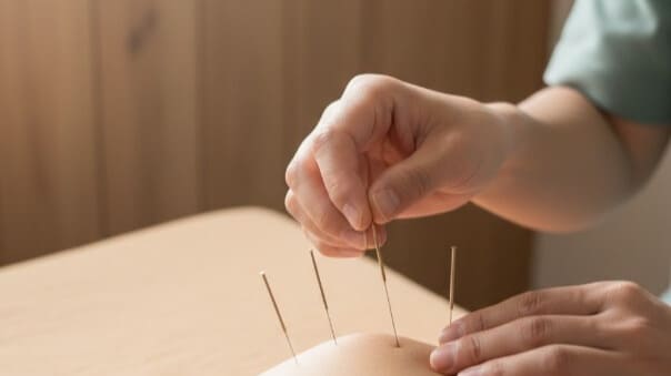 鍼灸師が患者の肩に鍼治療を施す手元のクローズアップ