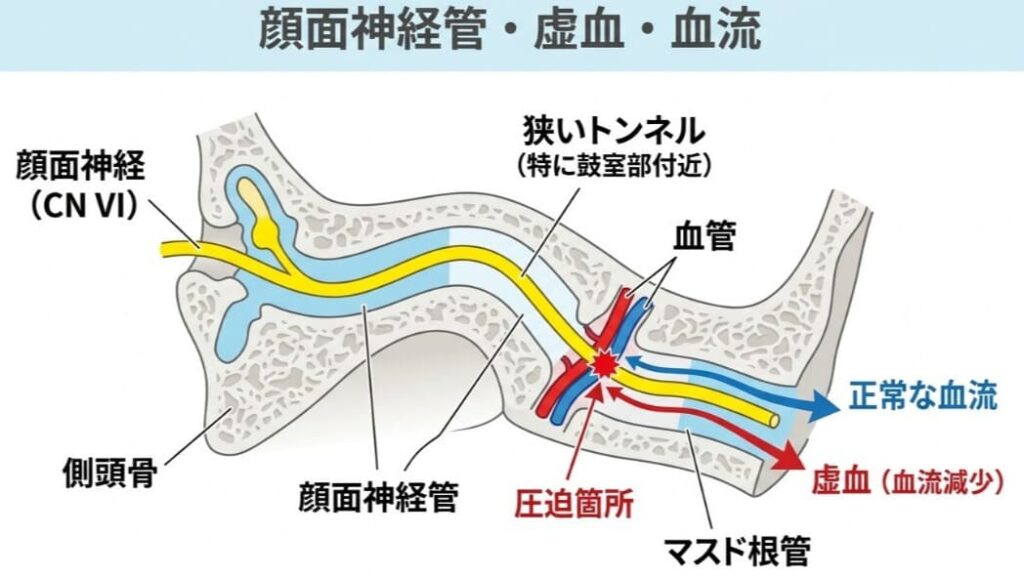 顔面神経管の狭いトンネル構造と血流が圧迫される仕組みを示した医療解説図
