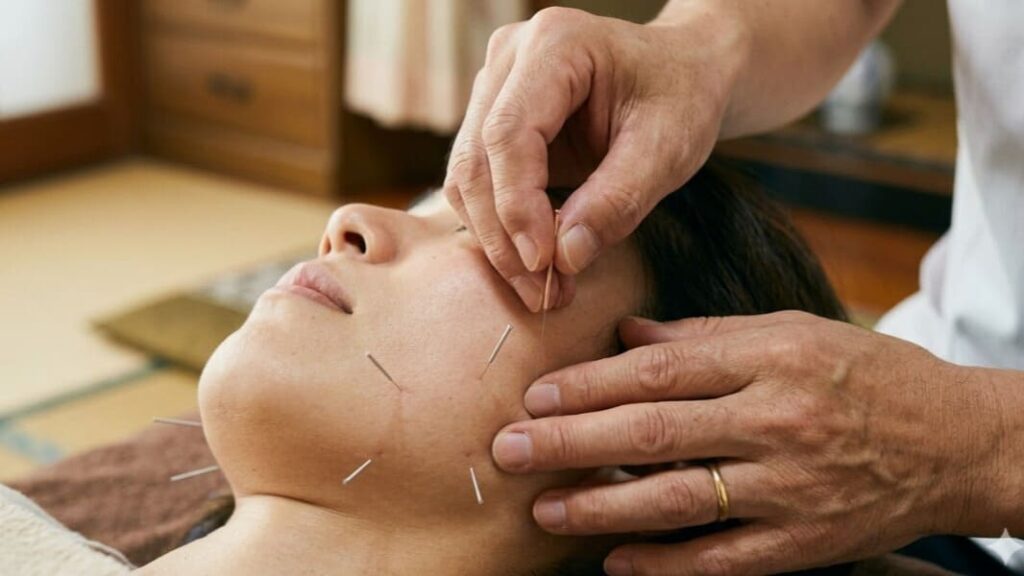 浜崎鍼灸整骨院で、鍼灸師が顔面神経麻痺の患者の首・肩に鍼を施術している様子