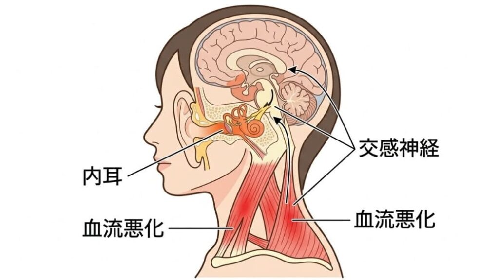 内耳のセンサー過反応から交感神経の過緊張・首の血流悪化までのメカニズムを示した図解